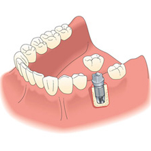Implants implants