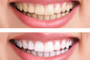 teeth-whitening1