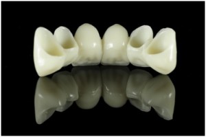 dental_bridge1